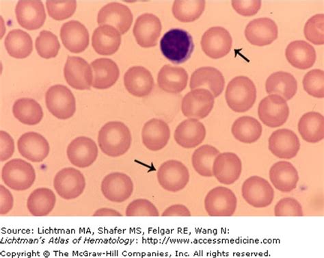 lab med cbc  blood cell abnormalities flashcards quizlet