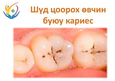 Шүд цоорох өвчин буюу кариес... - Гэгээн Ар Үр Эмнэлэг | Facebook