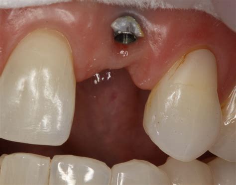 Esthetic Implant – What's in Your Mouth?