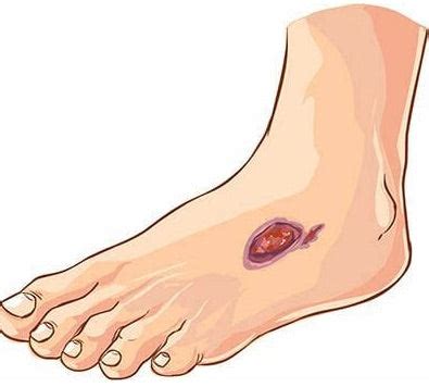 Prevention and Treatment: Non-Diabetic Foot Ulcer - Circufiber