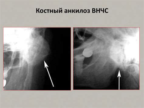 Острая травма ВНЧС у детей. Отдаленные последствия травмы ВНЧС ...