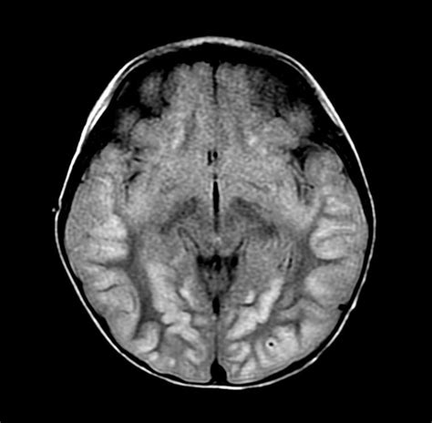 Anoxic brain injury MRI - wikidoc