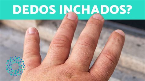 Dedos Inchados E Doloridos - Por que os DEDOS das MÃOS INCHAM? (+10 Motivos) 🖐️ (Como Desinchar ...