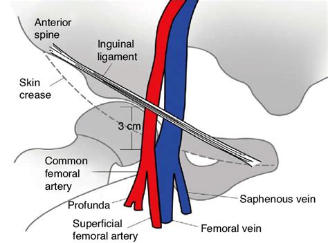 The anatomy relevant to percutaneous catheterization of the femoral ...