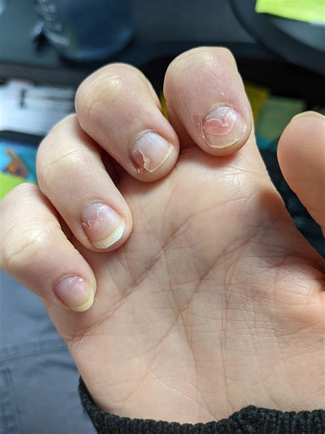 my nails have been breaking at the beds, discolored (had a black spot
