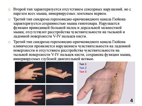 Туннельные синдромы верхней конечности - презентация онлайн