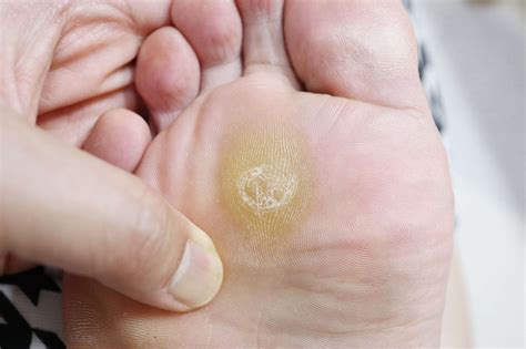 foot corns  callus leading health podiatry