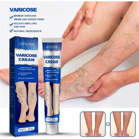 Qual A Melhor Pomada Para Varizes - Pomada-para-al-vio-das-varizes-creme-eficaz-para-aliviar-a-vasculite ...