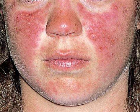 Sustavni lupus eritematozus (SLE) - Solmed Clinic