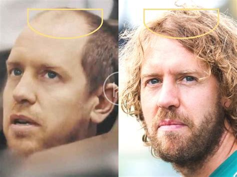 Sebastian Vettel Hair Transplant - Hair Loss & Technical Analysis