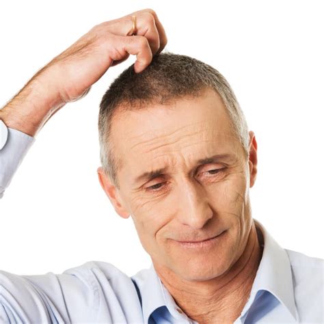 Lexapro and Hair Loss - Dr Resul Yaman Hair Clinic