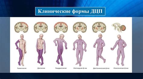 Детский церебральный паралич - презентация онлайн