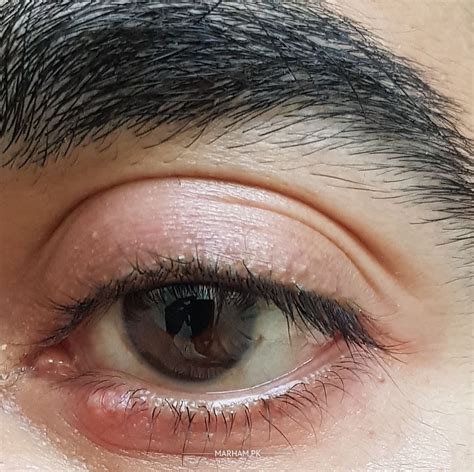 eye specialist   swollen eyelid