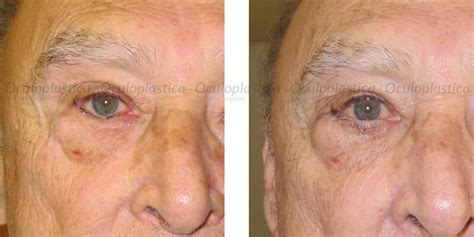 Entropion | Solve the problem Oculoplastica | Dr Graziani
