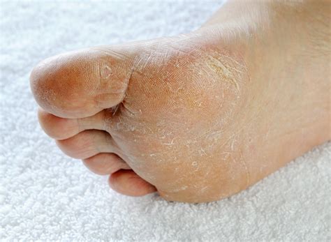 Rheumatoid Arthritis Feet