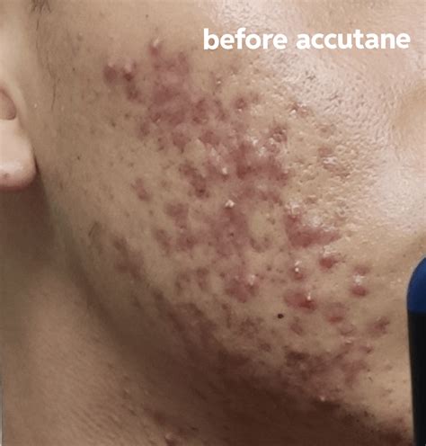 Acne scars : r/AcneScars