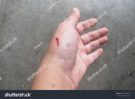 minor wound images stock  vectors shutterstock