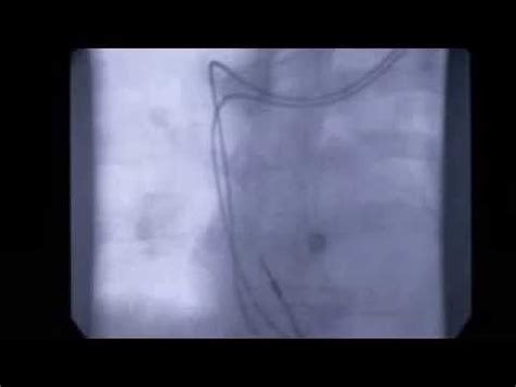 MRI-safe pacemaker video - YouTube