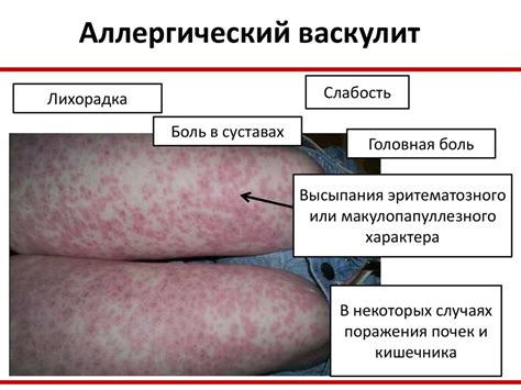 Особенности лекарственной аллергии - презентация онлайн