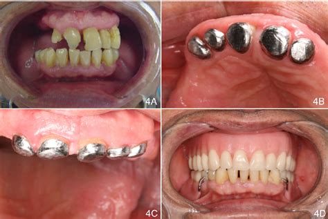 Figure 4 from Five-year of tooth-supported overdenture as prosthetic ...