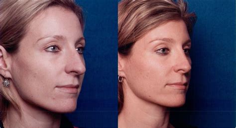 The Nose Clinic | BEFORE & AFTER NOSE SURGERY PHOTOS 52