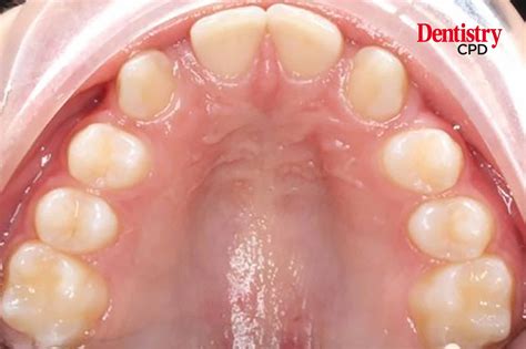 Dentistry CPD - Management of hypodontia