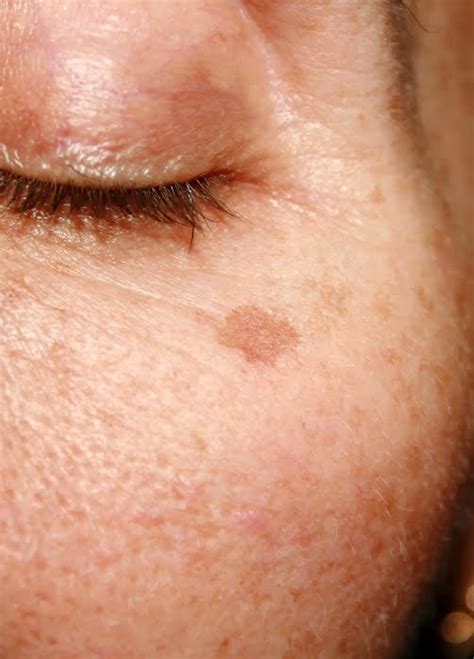 age spots kalpana aesthetics