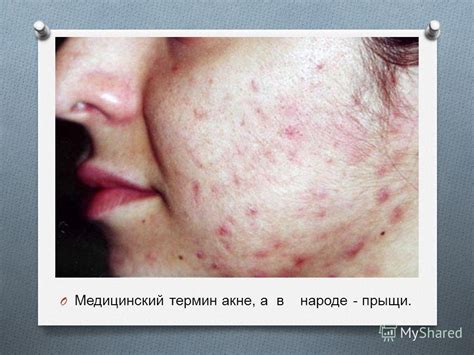 Презентация на тему: "Акне. Причины, симптомы, лечение Автор : Фельде ...