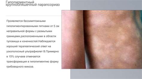 Крупнобляшечный парапсориаз - online presentation