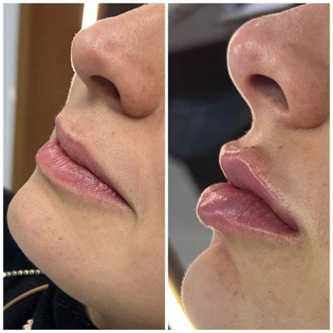 Preenchimento Grandes Lábios Antes E Depois - Preenchimento labial: Antes e depois