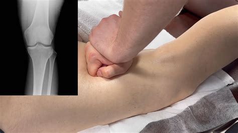 Почему болят колени?! Как вылечить в домашних условиях. #гонартроз # ...