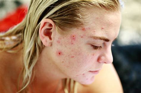 What causes hormonal acne? Here are the 5 major hormones involved in ...