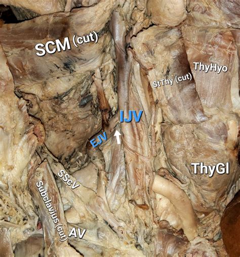 A Rare Anastomosis Between the Internal and the External Jugular Veins