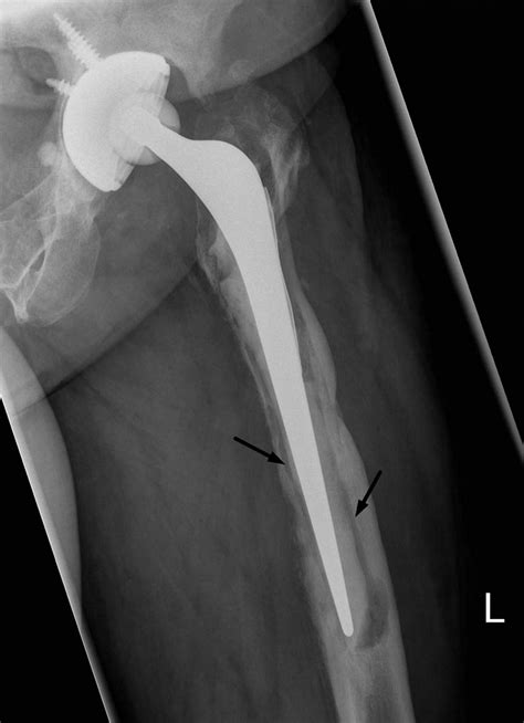 Diagnosis and management of prosthetic joint infection | The BMJ