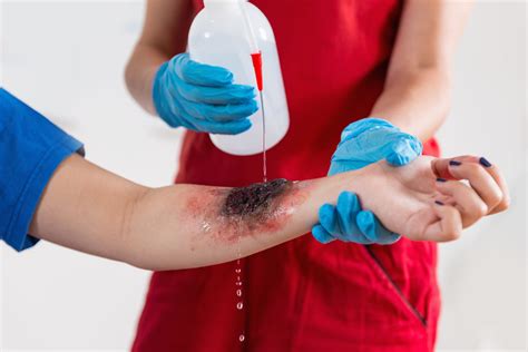 Overview of Burns and How You Should Respond to Them