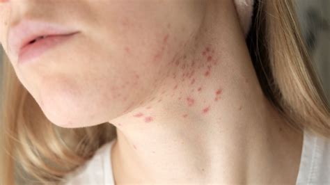 What Should You Do About Stubborn Acne On Your Neck?