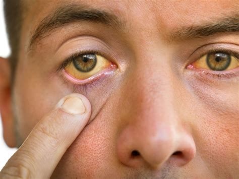 5 warning signs of high cholesterol on your face and eyes - New Health