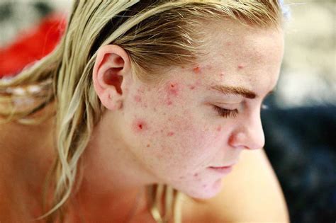 Reduce Androgens In Females Naturally: 10 Best Ways
