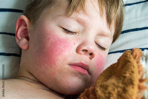 viral disease measles rash   body   child allergy stock