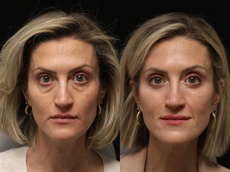 Before and 7 months after lower blepharoplasty surgery with lower lid