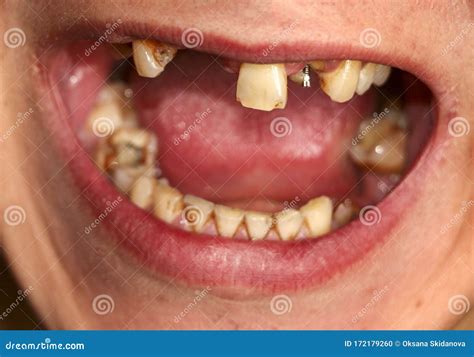 Открытый рот со сломанными больными зубами и Periodontitis костоедой ...