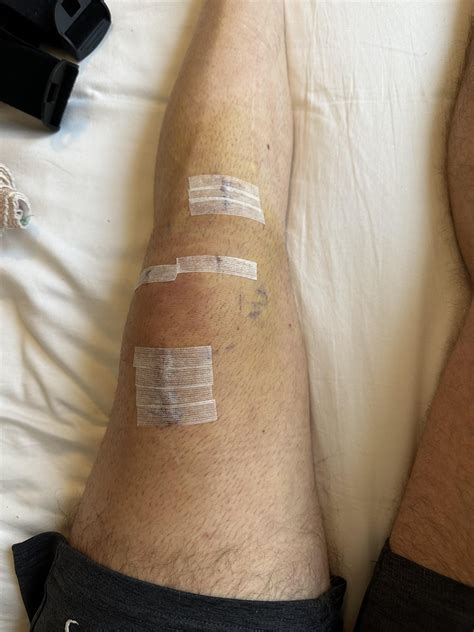 Quad tendon ACL reconstruction 1 week ago today and feeling great. Had