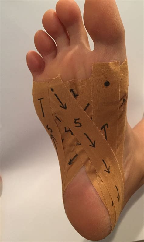 Heel Pads For Plantar Fasciitis : Plantar Fasciitis explained in a