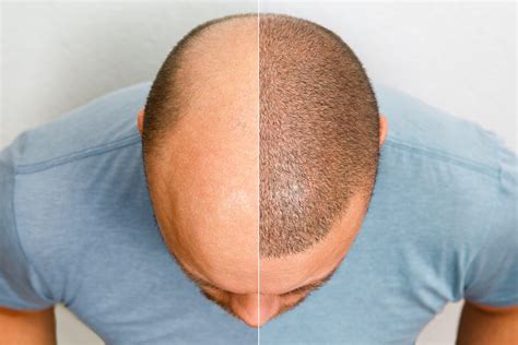 hair transplant timeline chart westmodern clinic