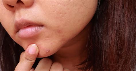 What to Know About Treating Cystic Acne, Per Dermatologists | PS Beauty