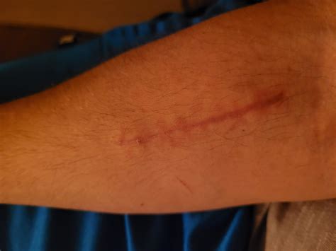 Have any of you torn/detached your bicep at the elbow?