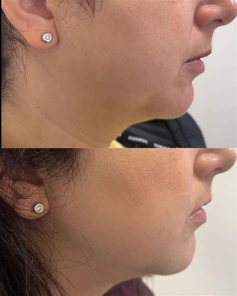 What's Really Happening in Those Jaw-Dropping Before and After Adverts 1