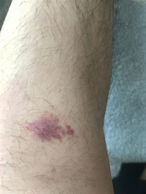 type  bite   rmedical