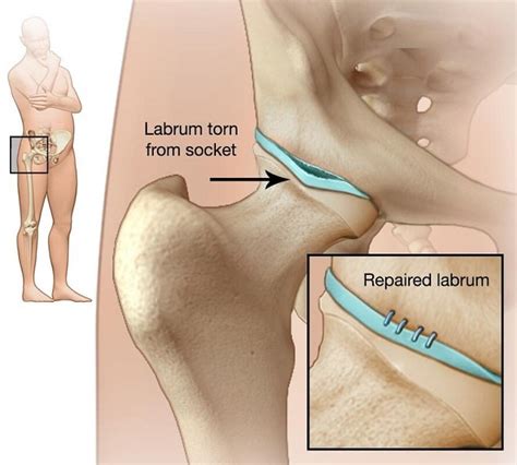 An elevated hip experience: Mayo Clinic treatment for hip impingement
