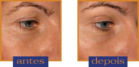 Colágeno Verisol Antes E Depois - Colágeno Hidrolisado Para Pele, Cabelos e Unhas, Com Verisol - NatuSoul